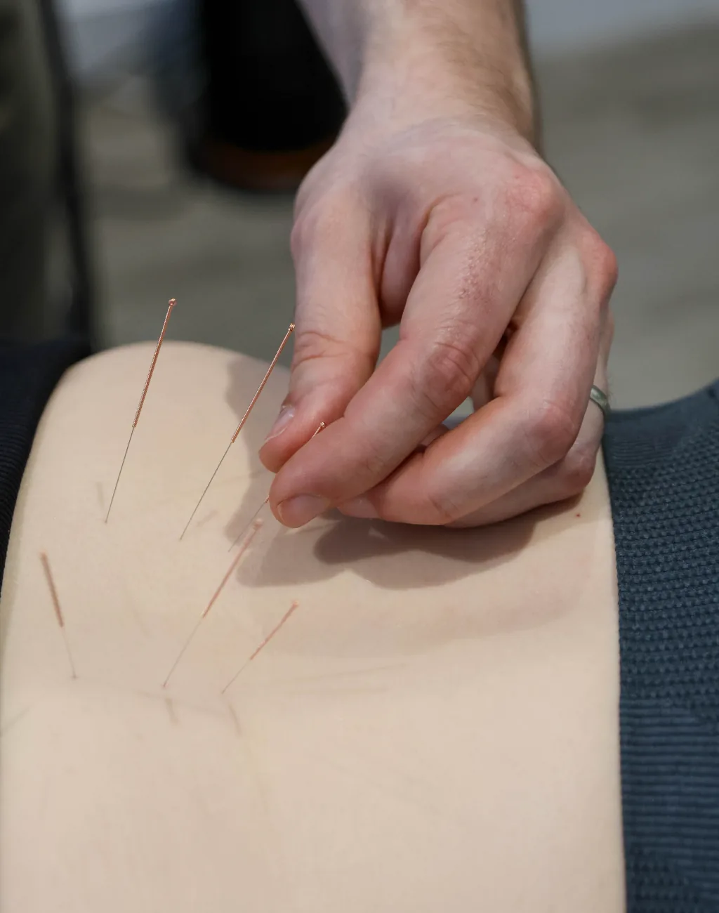 Medical acupuncture applied to the lower back during sciatica treatment in Rainham